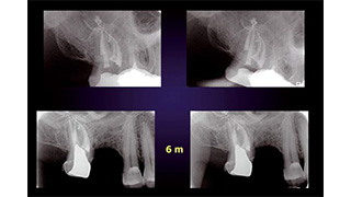 Endodontie : l’économie tissulaire du laser