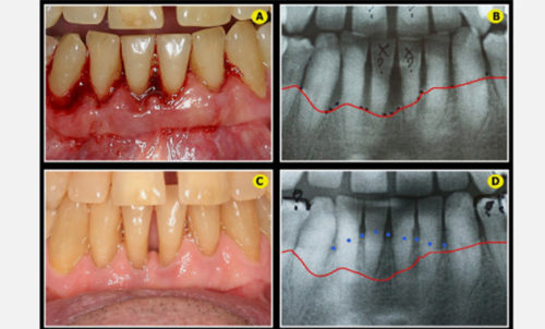 parodontites et peri-implantites